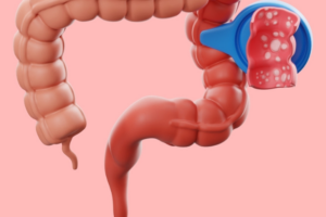 Κολίτιδα από Αντιβιοτικά